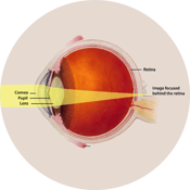 Presbyopia Round.png